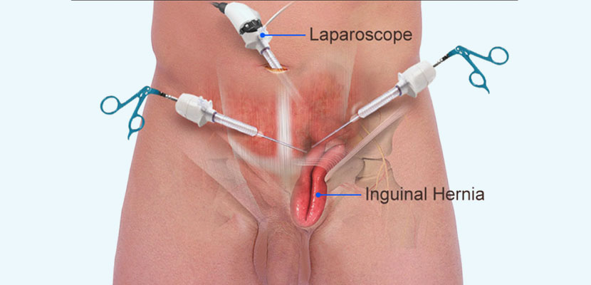 Minimally Invasive Hernia Surgery