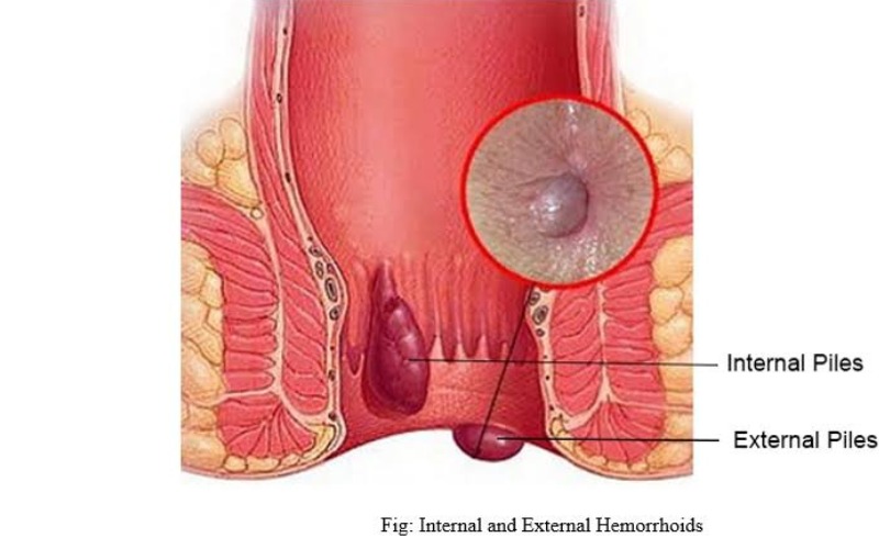 Laser Treatment for Piles